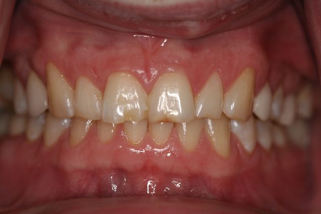 Veneers Case 3 - Before