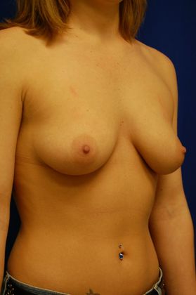 Breast Augmentation : Case 33 (11463) - Before