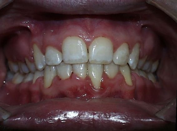 Periodontics and Braces: Periodontal and Crowded - After