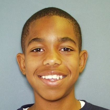 Open Bite: Open Bite and Crowding - Before 