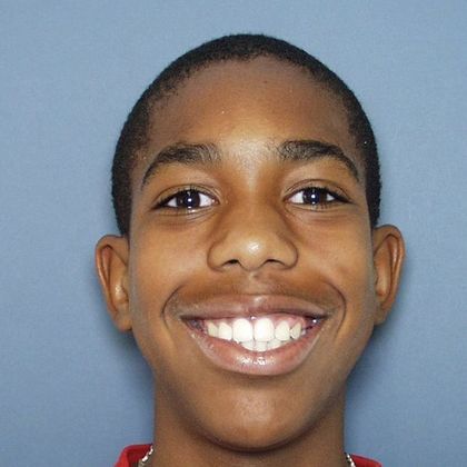 Open Bite: Open Bite and Crowding - After