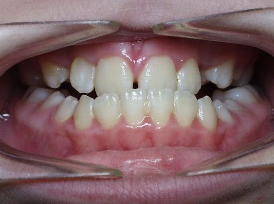 Under Bite with NO Surgery: Under Bite with Posterior Open Bite - Before