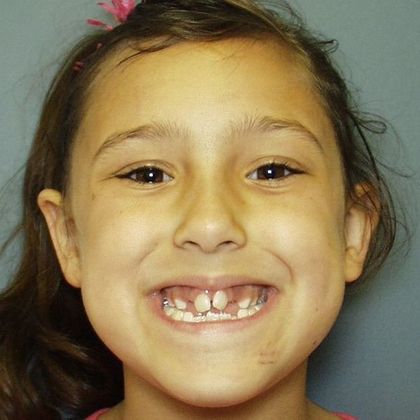 Children Smiles Open Bite and Very Narrow Arch - Before