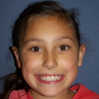 Children Smiles Open Bite and Very Narrow Arch - After