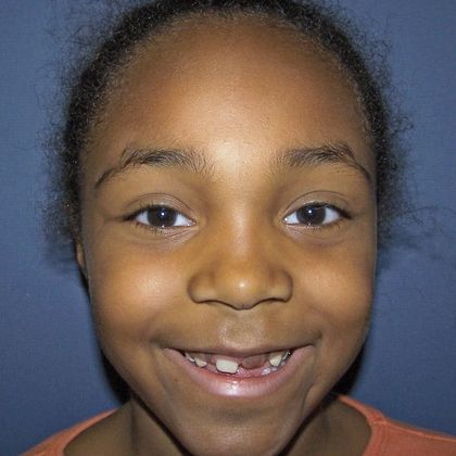 Children Smiles: Open Bite - Before 