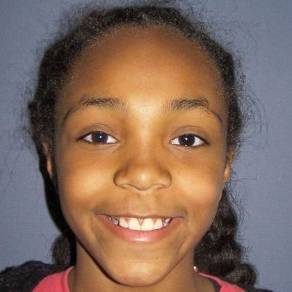 Children Smiles: Open Bite - After