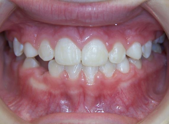 Children Smiles: Anterior Under Bite - After