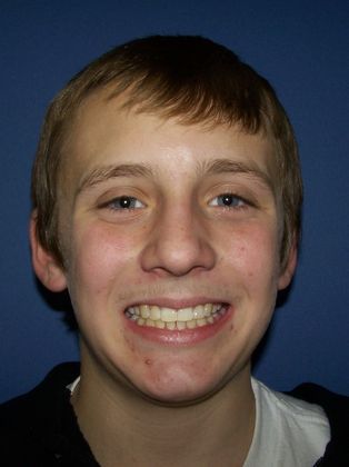  Crowding or Crooked Teeth Crowding  - After