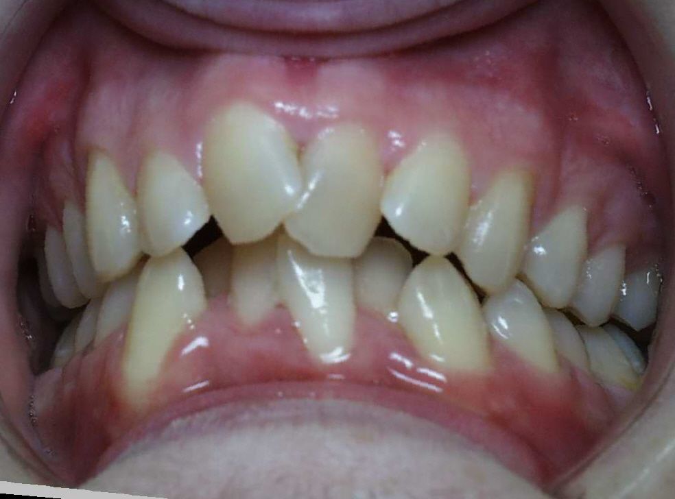 Over Crowded Narrow Mouth Narrow Arch/Narrow Smile Before and After