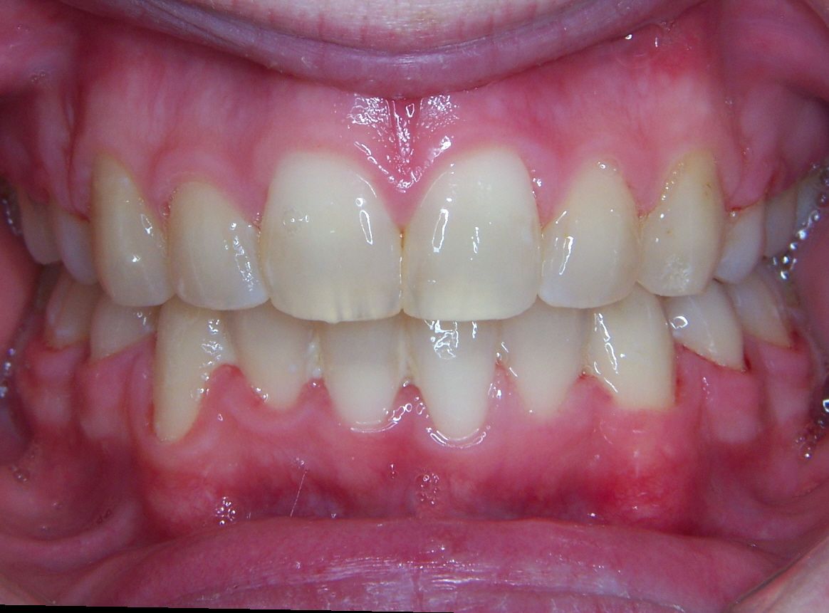 Over Crowded Narrow Mouth Narrow Arch/Narrow Smile Before and After