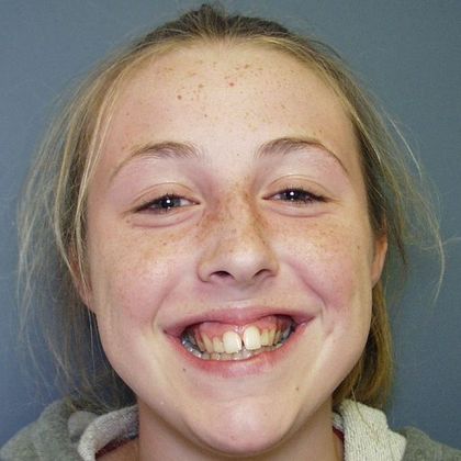 Narrow Arch - Narrow Smile: Over Bite and Narrow Arch - Before