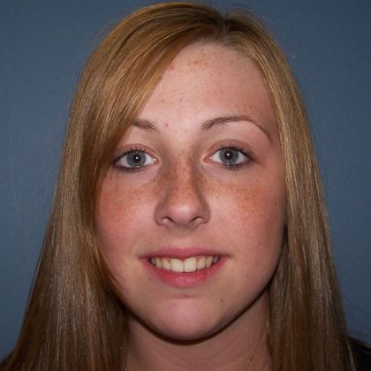 Narrow Arch - Narrow Smile: Over Bite and Narrow Arch - After