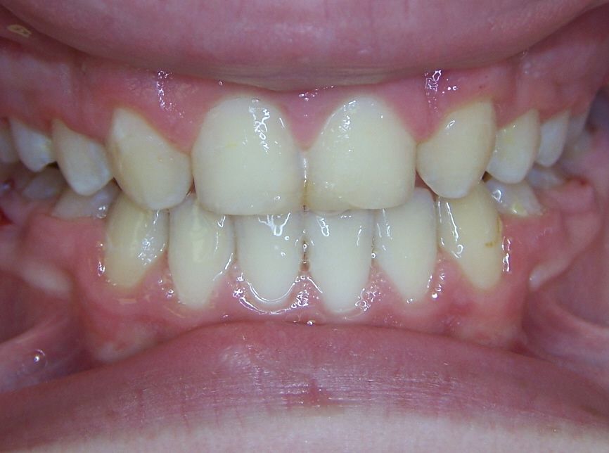 Mssing laterals - Missing Teeth and Braces - Before and After Gallery