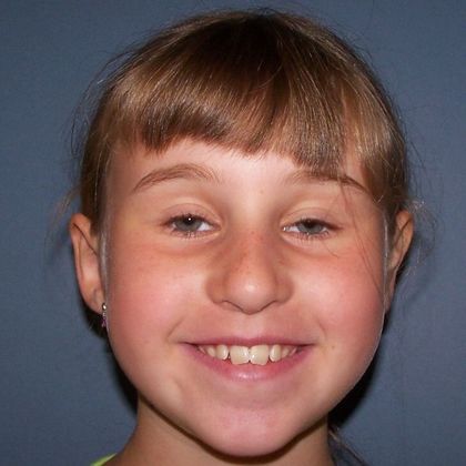 Children Smiles: Open Bite and Narrow Arch - Before