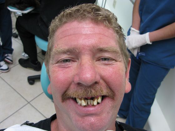 Full Mouth Dental Implant Rehabilitation: Case 1 - Before Full Mouth Dental Implant Rehabilitation