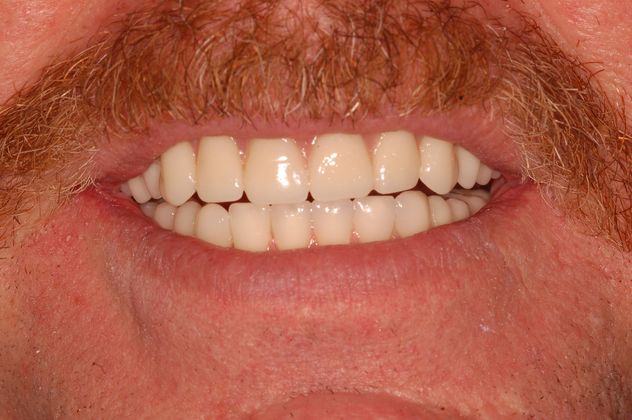 Full Mouth Dental Implant Rehabilitation: Case 1 - After Full Mouth Dental Implant Rehabilitation