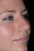 Rhinoplasty