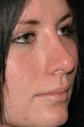 Rhinoplasty