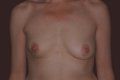 Breast Reconstruction