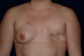 Breast Reconstruction