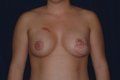 Breast Reconstruction