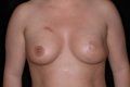 Breast Reconstruction