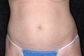 Liposuction