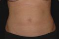 Liposuction