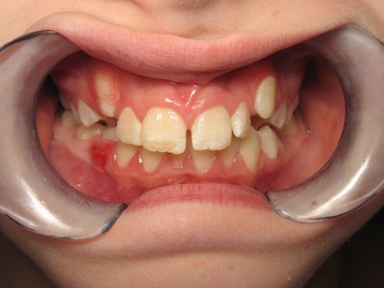 Orthodontics Case C - Before