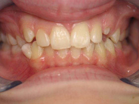 Orthodontics Case I - Before