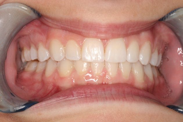 Orthodontics Case I - After