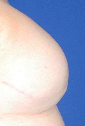 Breast Nipple & Areola : Case 4 (12177) - Before, right breast profile