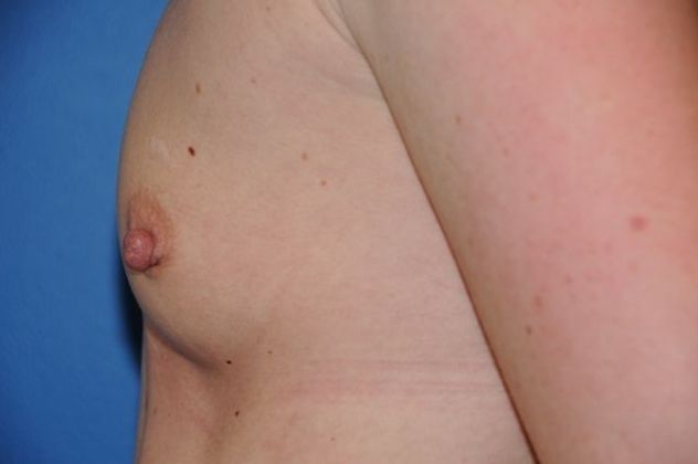 Breast Augmentation / Enhancement Case 2 - Before