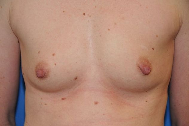 Breast Augmentation / Enhancement: Case 2 - Before
