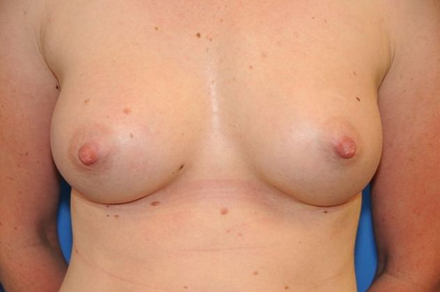 Breast Augmentation / Enhancement: Case 2 - After