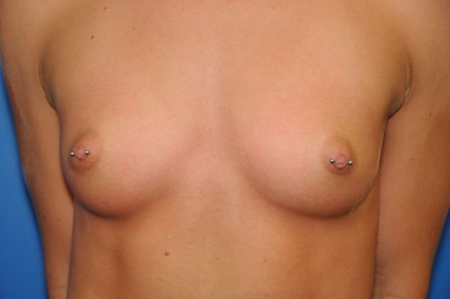 Breast Augmentation / Enhancement: Case 3 - Before