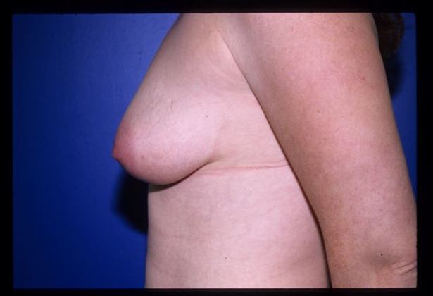 Breast Augmentation / Enhancement Case 4 - Before