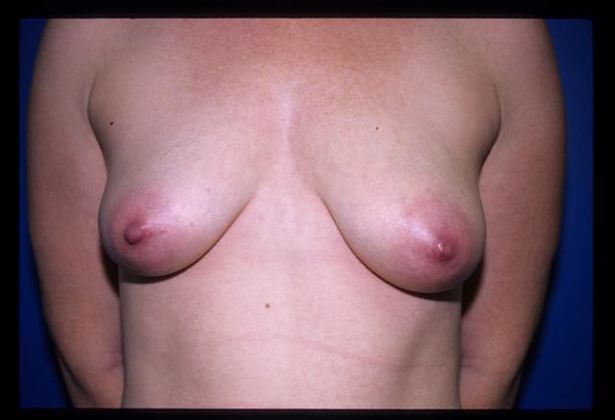 Breast Augmentation / Enhancement: Case 4 - Before