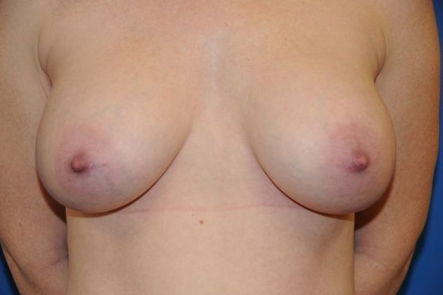 Breast Augmentation / Enhancement: Case 4 - After
