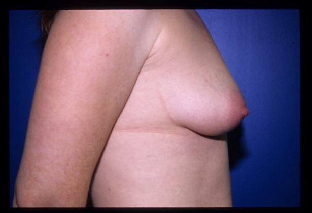 Breast Augmentation / Enhancement: Case 4 - Before