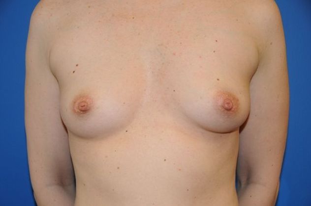 Breast Augmentation / Enhancement: Case 5 - After