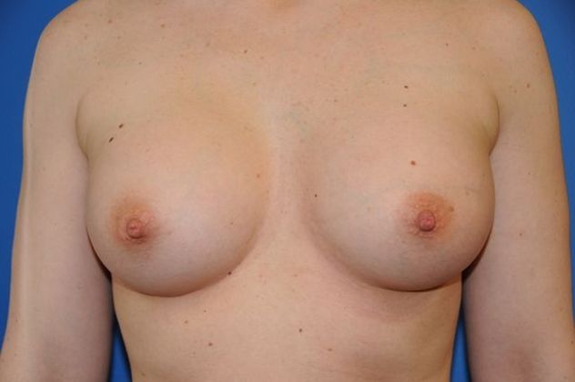 Breast Augmentation / Enhancement: Case 5 - After