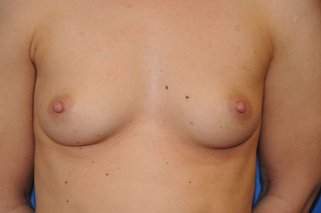 Breast Augmentation / Enhancement: Case 6 - Before