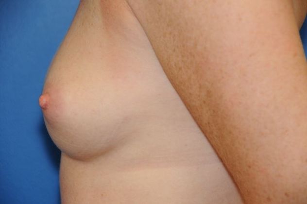 Breast Augmentation / Enhancement Case 7 - Before