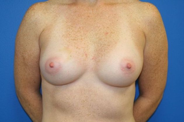 Breast Augmentation / Enhancement: Case 7 - After