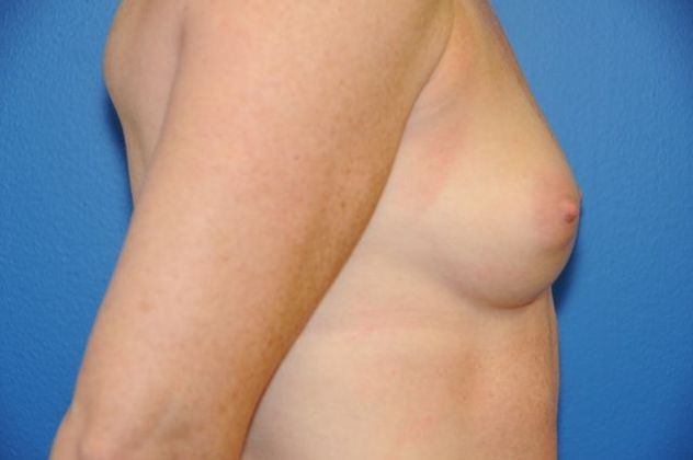 Breast Augmentation / Enhancement: Case 7 - Before