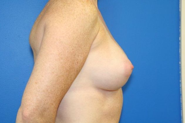 Breast Augmentation / Enhancement: Case 7 - After