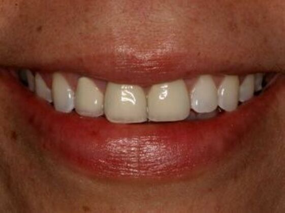 Smile Makeover Case 5 - Before