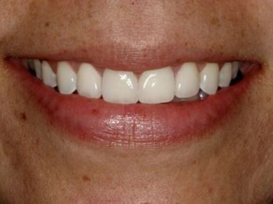 Smile Makeover Case 5 - After
