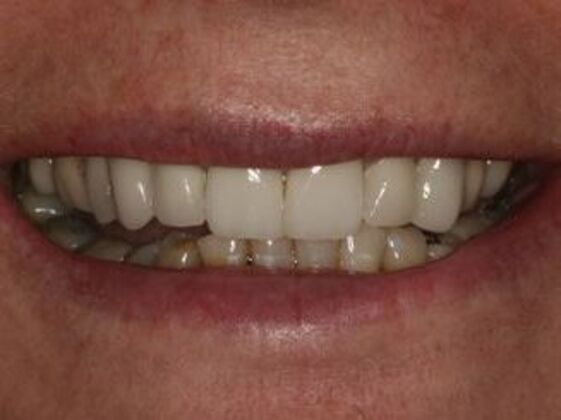 Smile Makeover Case 3 - Before